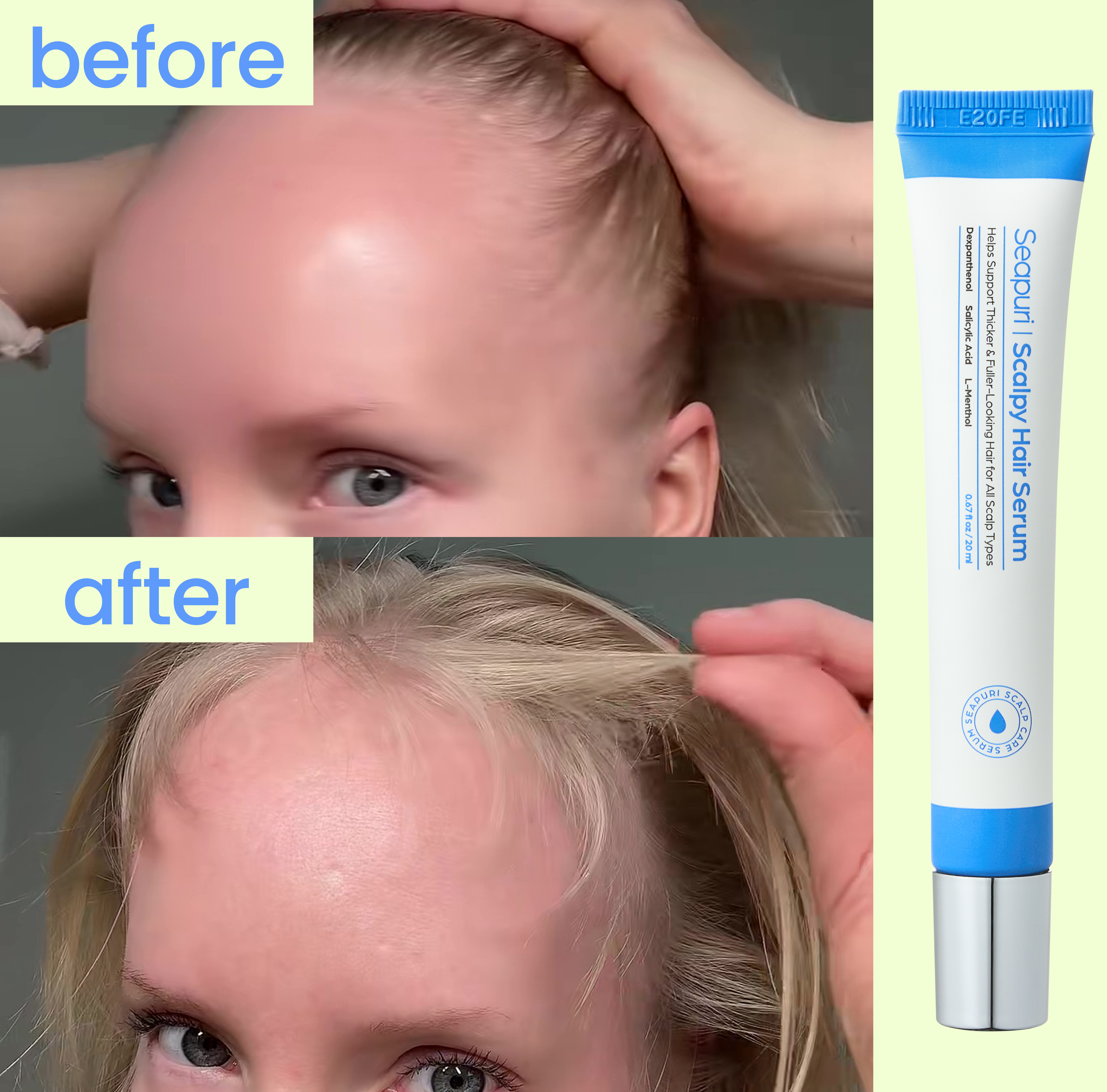 [2 Meses de Cuidado Intensivo] Scalpy Hair Serum 3+1